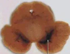 正凡人：正常黑质