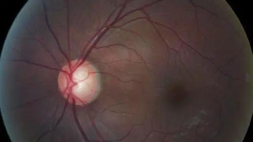 青光眼的克星来袭，，，，助力患者远离视力的“窃贼”